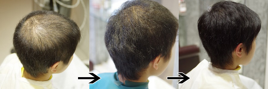 抜毛症でお悩みの方へ 愛媛エクステ増毛 Hair Salon A La Mode Nakagawa